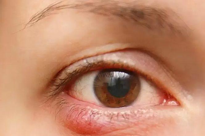 التهاب لبه پلک یا بلفاریت