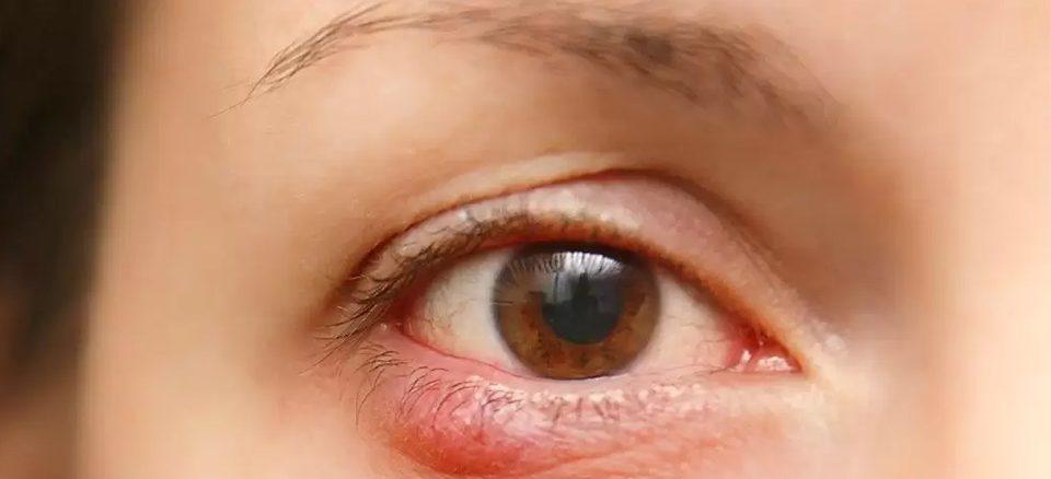 التهاب لبه پلک یا بلفاریت